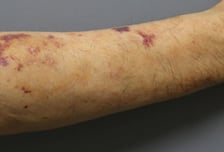 추석에 만난 할머니, 팔이 멍투성이인데 "안 아파"…'이것' 의심해야