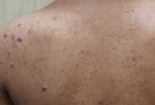 "등이 왜 그래?"…여드름 손으로 뜯었더니 간지러운 팥알 '툭튀'