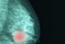 조기 유방암 환자, 재발 예측 점수 낮으면 안심? '이것' 높으면 표적항암 받아야