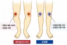 관절염 고생하는 우리 엄마 '오다리'라면…"쫙 피는 수술해야"