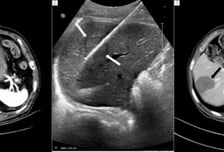 "열·전기로 암세포 파괴" 매년 3000여건 시행…재발·전이암에 큰 효과
