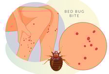 "너무 가려워" 벅벅…'빈대' 물린 곳에 물파스, 효과 있을까? [한 장으로 보는 건강]