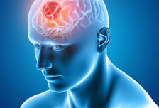 죽는 병?…무서운 소문 많은 '뇌종양', 무슨 병이기에