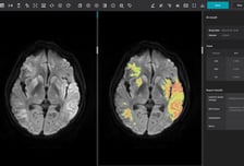 '의료AI 1호' 제이엘케이 "뇌졸중 '풀 솔루션'으로 글로벌 경쟁력 강화"