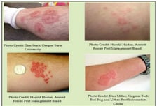 빈대 물리고 "숨 안 쉬어져요"…아나필락시스도 부른다