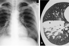 中 휩쓴 이 '폐렴', 독감과 같이 걸린다면…의사 "비극 생길 수도"