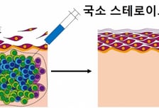 희귀질환 '천포창'의 만성 물집, 국소 스테로이드 주사도 효과적