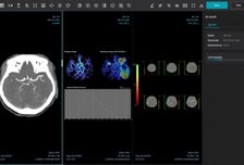 제이엘케이, 북미영상의학회서 '뇌경색 AI 솔루션 ' 임상 결과 발표