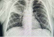 '이 폐렴' 걸린 아이들 급증에도…질병청 데이터에 '아동병원' 빠진 이유