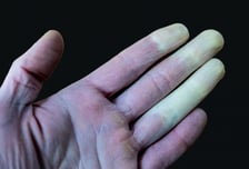 손 꽁꽁 얼었는데 "겨울엔 다 이래"…'하얀 손가락' 방치했다간 절단 위기