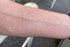 BTS 뷔도 "알레르기 때문에 가렵다"‥일상 방해 '빨간 닭살' 뭐길래