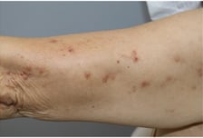 "가려워" 긁다 못해 후벼 판다…손댈수록 악화하는 '이 질환' 뭐길래