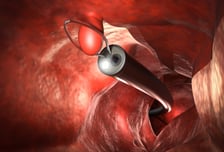 조기 대장암, 배 열지 않고 내시경으로 '싹둑'…전이 위험도 따져 환자 추린다