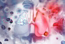 2년도 못 사는 '돌연변이 폐암' 차세대 항암제로 무진행생존기간 2배↑