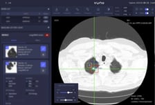 뷰노, '흉부 CT' 인공지능 솔루션 日 보험급여 대상 인정