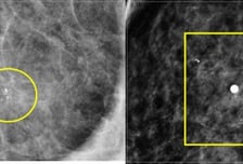 가슴 멍울 없었는데 '하얀 가루' 찍혔다?…유방암은 이런 모습