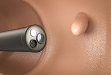 용종 10개 중 9개는 '대장암 씨앗'…정확한 내시경, 나 하기 나름?