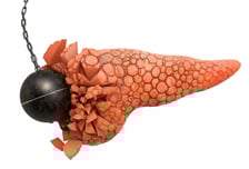 갑자기 생긴 당뇨병 '이 암' 때문?…'기름 낀 대변' 그냥 넘기면 안 돼