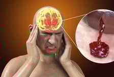 "한번도 경험해보지 못한 두통"…환자 68% 급증한 이 질병