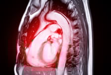 "풍선 넣고 판막 펼치면 끝" 늙고 병든 '심장 문지기' 개흉 없이 고친다