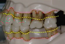 "양치 귀찮아" 자꾸 건너뛰다간…입 냄새 '풀풀' 잇몸뼈 녹아내린다