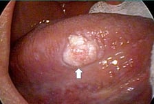 담배 피워서 걸리는줄 알았더니…여성들한테도 급증한 '이 암'