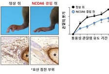 "출산 버금가는 고통" 통풍 유발 단백질, 韓의료진이 세계 최초 규명