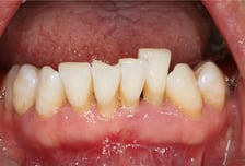 칫솔질 너무 열심히 해도 탈?…잇몸 내려앉아 웃지도 못하는 '이 병'