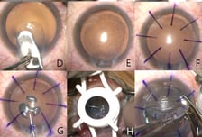 "각막 터질 위험 없어" 망막반사 이용한 새로운 각막이식술 나왔다
