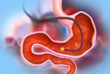 "소화 안되고 속쓰려" 위 문제만이 아니다?…내시경 보니 '이곳' 염증