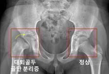 외상없었는데 허벅지뼈 분리? 호르몬 3개 부족하면 발병률 744배↑