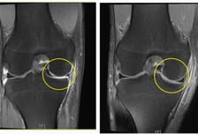 괜찮아지겠지?…무릎서 "사각사각" 연골의 '비명'