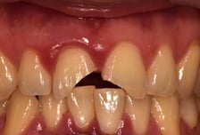 "빠진 치아, 뿌리 말고 머리 잡으세요" 상황별 치아 응급상황 대처법