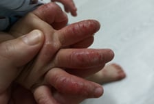 "아기 온몸이 피투성이"…'연 800만원' 영유아 아토피약, 80만원대로