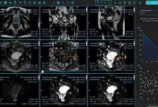 제이엘케이, 전립선암 진단 AI 솔루션 FDA 승인…"미국 진출 속도 높인다"