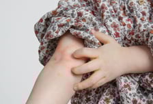 밤새 긁다가 피 봤다…아이들 '중증 아토피'  8년 새 2배 늘어