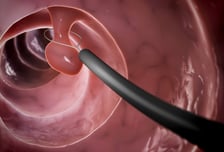 젊은 대장암 환자 사망 위험, '이 기술' 적용했더니 예측 정확도 90%