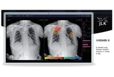 제이엘케이 폐 질환 AI 솔루션 'Jviewer-X' 네이처 자매지서 효과 입증