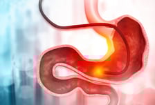 배 째야 하는 줄…한국인이 잘 걸리는 '위암' 효과적인 수술법은?