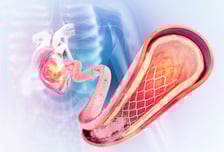 스텐트 시술받고도 심장병 재발하는 이유…韓 연구진 세계 최초로 밝혀