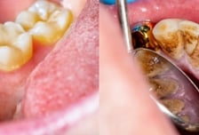 양치 살살해도 피나고 치아 '흔들'…잇몸에 달라붙은 '돌' 때문?