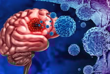 유한양행 '렉라자' 뇌 전이 4기 폐암도 효과…"절반 이상 암 줄어"