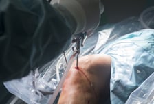 내 무릎 핀 박은 사람이 영업사원?…'한달 150건' 대리수술 병원 재판행