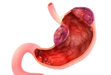 위내시경 검사받고 "종양입니다"…덜컥 겁부터 낼 필요 없는 이유