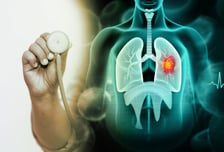 응급실서 폐암 놓쳐 '17억' 배상, 소송당사자는 외래 두 번 더 간 의사