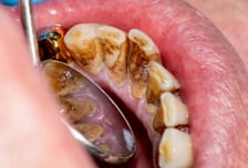 양치 살살해도 "피가 줄줄"…다닥다닥 붙은 '이것' 때문?