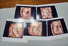 자연임신 다섯쌍둥이 국내 첫 분만 성공…"사전 시뮬레이션도 했다"