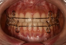 "돈 들였는데 치아 삐뚤빼뚤" 교정 후 '이것' 하면 원래대로 옵니다