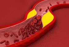 "LDL 콜레스테롤 낮추자" 바람 불더니…치료율 오르고 혈관질환 줄어