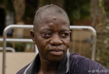 엠폭스 의심환자 느는데…비축한 백신 58% 유효기간 지났다